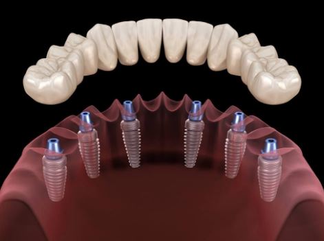 https://www.vardhamandentalhospital.com/wp-content/uploads/2023/06/SD2.jpg