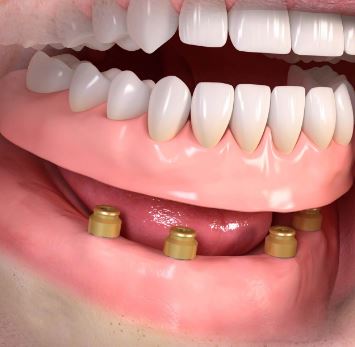https://www.vardhamandentalhospital.com/wp-content/uploads/2023/06/SD3.jpg